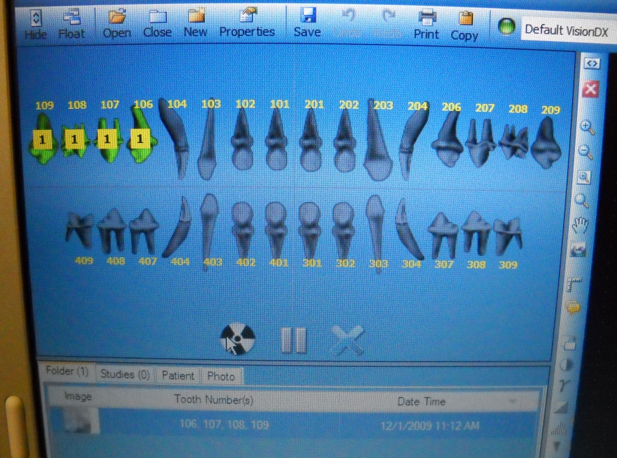 The images produced by the digital dental sensor are stored on a computer.